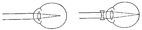 FIG. 81.—The nearsighted eye. The defect is remedied
by concave glasses.